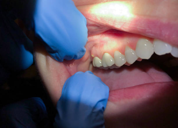 Best Emergency Root Canal Treatment in Homer, GA